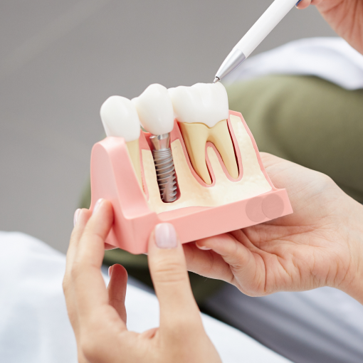 Pose d’implant dentaire à Brumath